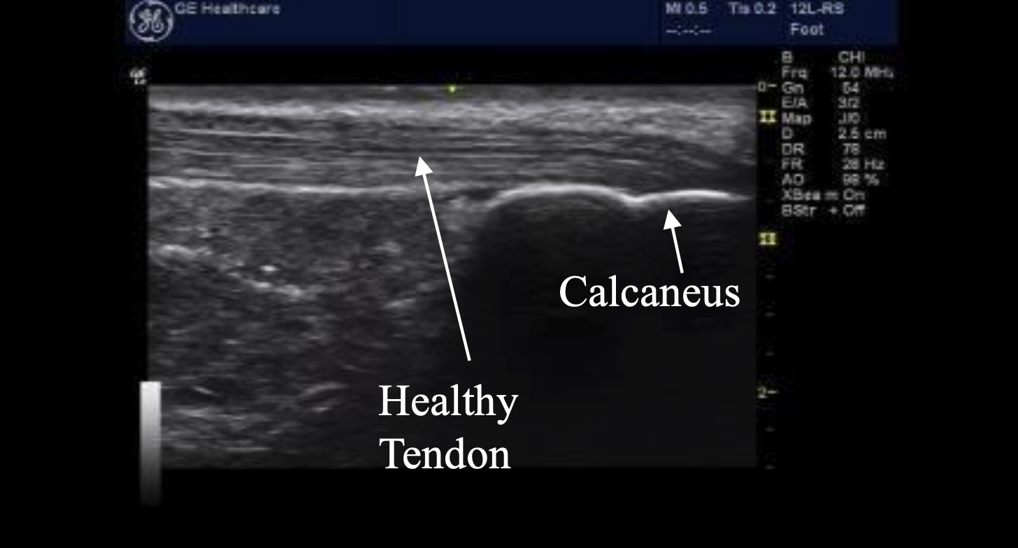 Healthy Achilles Tendon Ultrasound